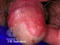 Balanitis