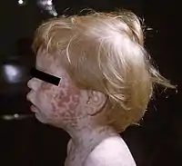 Young boy displaying the characteristic maculopapular rash of rubella