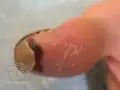 10 days after fluoride burn