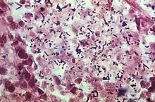 Photomicrograph reveals the presence of numerous Gram-positive, Listeria monocytogenes bacteria, harvested from the lung of a newborn with listeriosis.