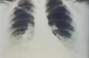 A chest x-ray showing the early stages of bilateral pulmonary effusion due to hantavirus pulmonary syndrome (HPS). HPS begins with interstitial pulmonary edema, progressing to alveolar edema with severe bilateral involvement. Pleural effusions are common.