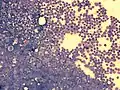 bone marrow smear from a person with acute lymphoblastic leukemia