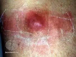 Abscess formed 2 months after procedure