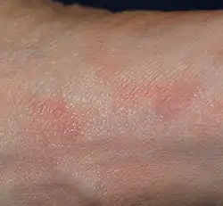 Scabies of the foot