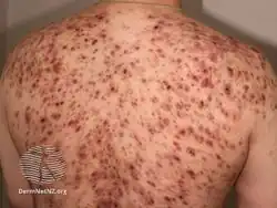 Acne affecting the back images