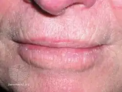 Actinic cheilitis