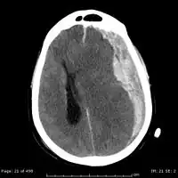 Acute-on-chronic subdural hematoma