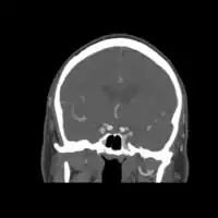 Carotid artery dissection