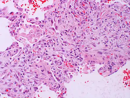 Acute interstitial pneumonia (AIP)/Idiopathic DAD