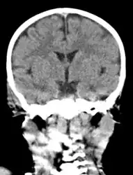 Acute mastoiditis