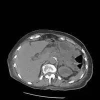 Acute on chronic pancreatitis