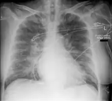 Acute pulmonary edema