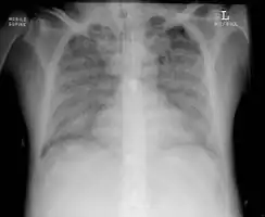 Acute respiratory distress syndrome