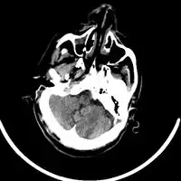 Acute right MCA stroke-Non-enhanced CT scan of the brain demonstrates early signs of right MCA territory infarction noted as loss of right insular ribbon sign due to cortical edema and loss of grey-white matter differentiation with obliteration of the Sylvian fissure secondary to edema