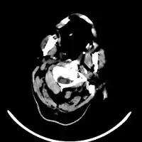 Acute right MCA stroke