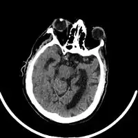 Acute right MCA stroke