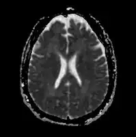 Acute severe hepatic encephalopathy