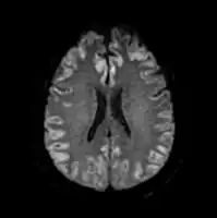 Acute severe hepatic encephalopathy