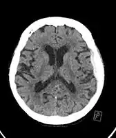 Acute traumatic subdural hematoma