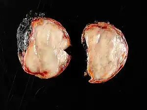 Ganglioneuroma of the adrenal gland