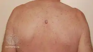 Amelanotic melanoma on the back