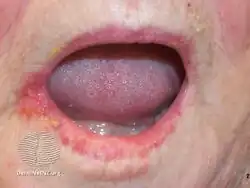 Angular cheilitis