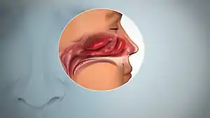 A side view anatomical drawing of the nasal sinuses depicting inflamed mucosa.