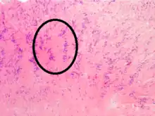 Antoni A area of schwannoma with Verocay bodies (one annotated by circle)