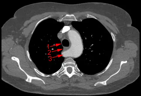 Aberrant subclavian artery at axial CT-scan. (1) trachea, (2) esophagus, (3) Aberrant subclavian artery.