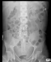 Ascites on AXR