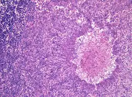 Histopathology of aspergilloma, H&E staining