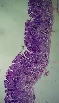 Atrophic gastritis under low power. H&E stain.