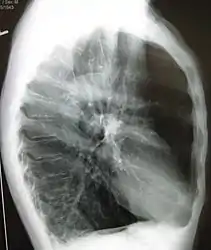 A lateral chest X-ray of a person with emphysema: Note the barrel chest and flat diaphragm.