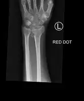 Bilateral Colles fractures/frontal