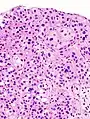 Histopathology of urothelial carcinoma of the urinary bladder, showing a nested pattern of invasion. Transurethral biopsy. Hematoxylin and eosin.