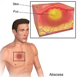 A diagram of an abscess.