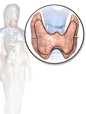 Illustration depicting enlarged thyroid that may be associated with hyperthyroidism