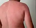 Skin peeling following sunburn