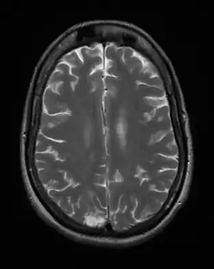 Cerebral toxoplasmosis