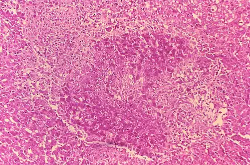 Granuloma and necrosis in the liver of a guinea pig infected with Brucella suis