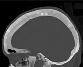 CT shows focal areas of osteosclerosis.