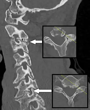 CT scan of a man presenting with radiculopathy of the left cervical spinal nerve 7, corresponding to spondylosis with osteophytes between the vertebral bodies C6 and C7 on the left side, causing foraminal stenosis at this level (lower arrow, showing axial plane). There is also spondylosis of the facet joint between C2 and C3, with some foraminal stenosis at this level (upper arrow), which appears to be asymptomatic.