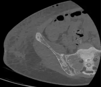 Subchondral resorption in the sacroiliac joint.