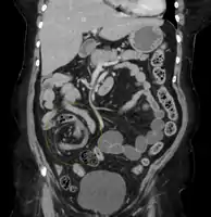 CT scan of a cecal volvulus