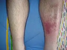 Redness and mild swelling of an adult leg