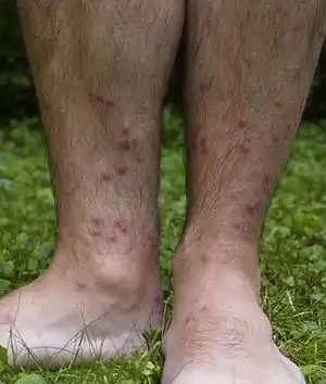 Multiple red bumps on the lower legs and feet