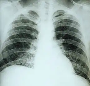 Chest X-ray of lungs affected by histoplasmosis