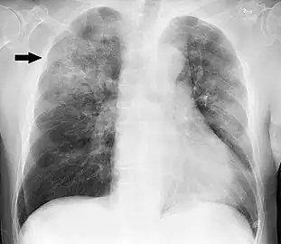 Chest X-ray of a case of Haemophilus influenzae, presumably as a secondary infection from influenza. It shows patchy consolidations, mainly in the right upper lobe (arrow).