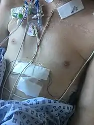 Chest scar after heart transplant