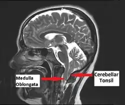 Chiari 1.5